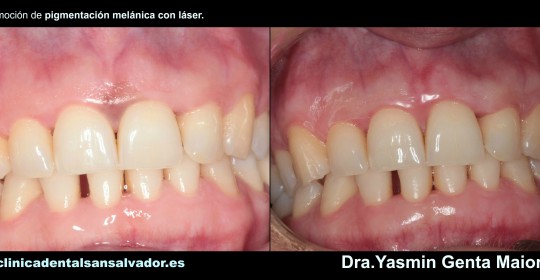 Dra.Yasmin Genta Maiorano remocion de pigmentacion melanica con laser clinica dental san salvador vigo