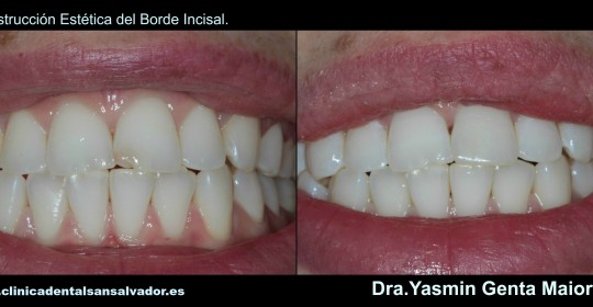 reconstruccion estetica clinica dental san salvador vigo dra yasmin genta maiorano