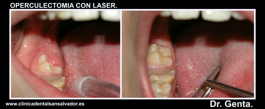 clinica dental san salvador vigo operculectomia con laser Dr. Daniel Genta.
