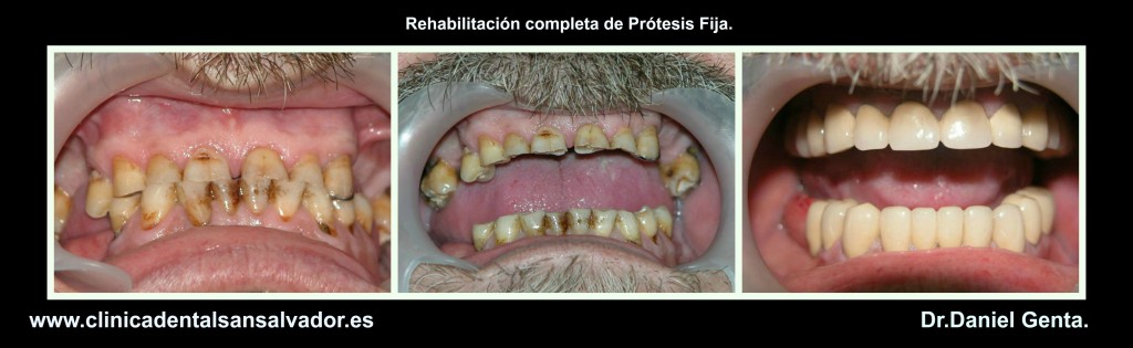 clinica dental san salvador vigo protesis fija rehabilitacion completa dr daniel genta.