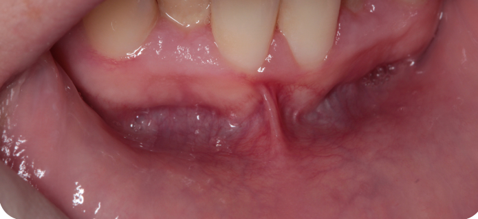 clinica dental san salvador vigo cirugia del frenillo inferior con laser1