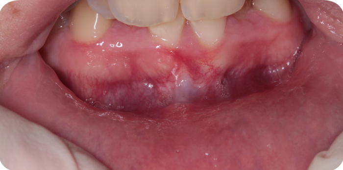 clinica dental san salvador vigo cirugia del frenillo inferior con laser2
